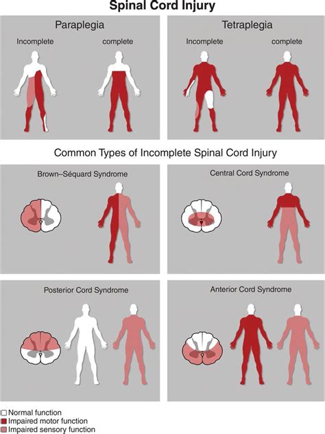 Paraplegia Causes