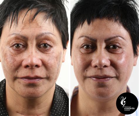 Melasma Treatment Melbourne - Victorian Cosmetic Institute