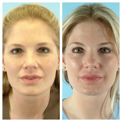 Dermal Fillers For Cheeks Before And After