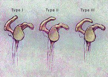 Type II/III Acromion