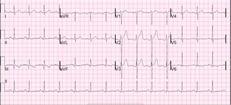 Dr. Smith's ECG Blog: Anterior ST elevation: Anterior STEMI? A mysterious case.