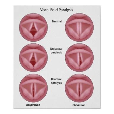 Paradoxical Vocal Fold Motion (Vocal Cord Dysfunction) - County EM