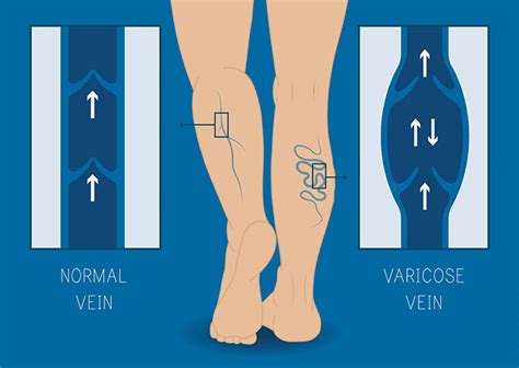 Lower Extremity Venous with Reflux Ultrasound | Cardiovascular Institute of the Shoals