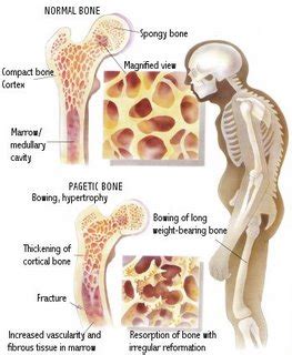 Paget's Disease of Bone - Jonathan Aarons MD/ Pain Management