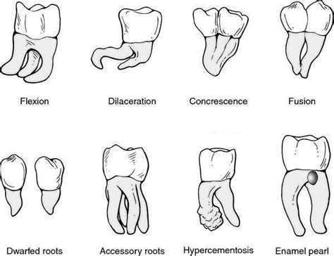 Developmental anomalies of tooth - Diagram ~ Dentistry and Medicine