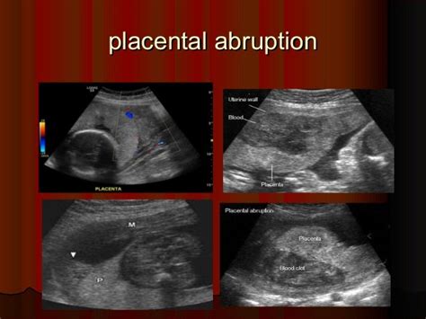 Placenta ultrasound