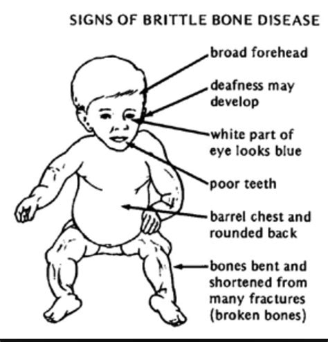 Bones Become Brittle Due To Deficiency Of at Bruce Villagomez blog