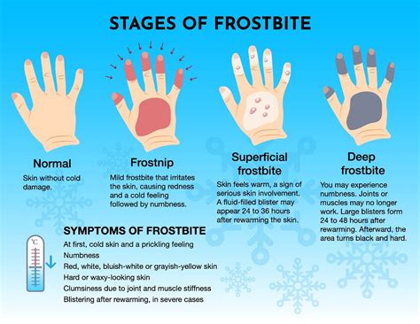 Frostbite symptoms: How cold does it need to be to get it and how fast ...