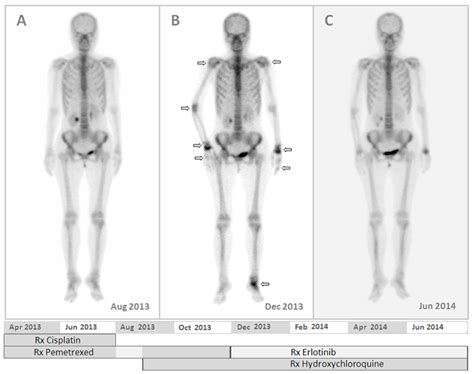 Abnormal Bone Scan