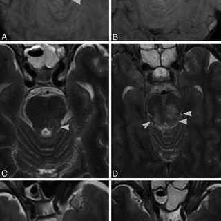 MRI features of brain stem lesions in 51 patients with severe head ...