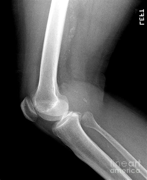 Lateral X-ray Of The Knee Photograph by Medical Body Scans