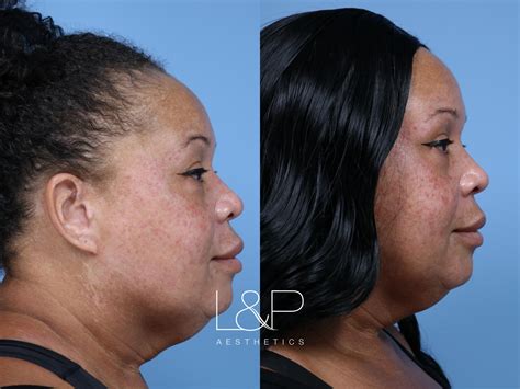 best ultherapy near me - Sinewy Weblogs Photographs