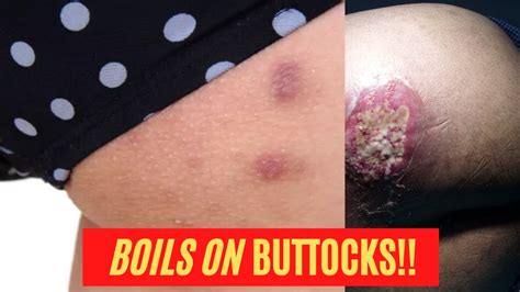 The 7 Most Effective Home REMEDIES for BOILS on BUTTOCKS | Boils BUTTOCKS Treatment for Quick ...