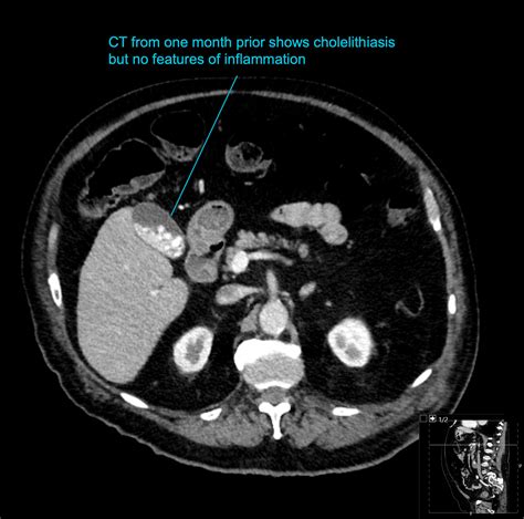 CT Case 059 • LITFL • CT scan interpretation