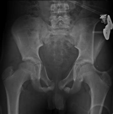 Pelvic Fracture X Ray