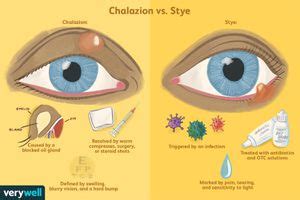 Chalazion vs. Stye: Symptoms, Causes, and Treatment