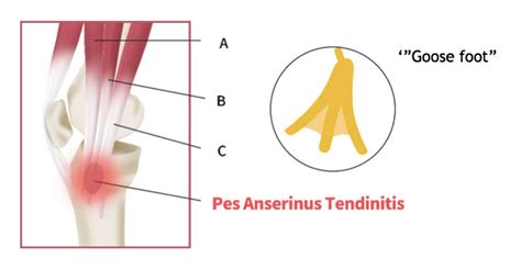 Pes Anserinus Pain Syndrome - Pregnancy Informations