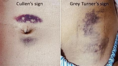 Cullen sign is a bluish discoloration of the periumbilical skin, while Grey Turner sign is an ...