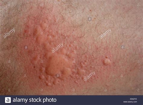 Nettle Rash Stock Photos & Nettle Rash Stock Images - Alamy