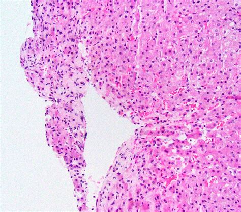 Pathology Outlines - Cardiac (congestive) hepatopathy and Fontan associated liver disease