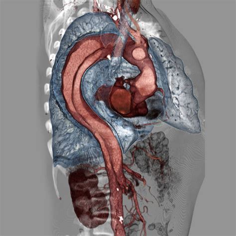 Aortic Dissection – Core EM