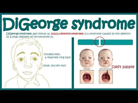 DiGeorge syndrome: symptoms, causes and treatment - psychology - 2024