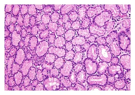 Histologic subtypes of IPMN based on histomorphology of the epithelia.... | Download Scientific ...