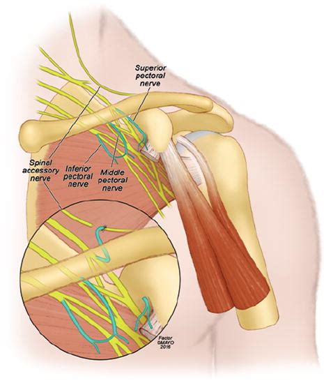 Lateral pectoral nerve transfer for spinal accessory nerve injury in: Journal of Neurosurgery ...