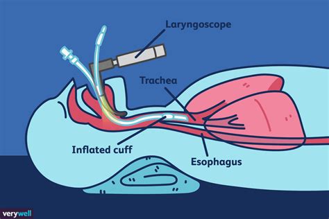 Nasal Endotracheal Intubation Under Fibreoptic Endoscopic | SexiezPicz Web Porn