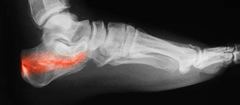 Calcaneal Apophysitis (Sever's Disease): symptoms and treatments