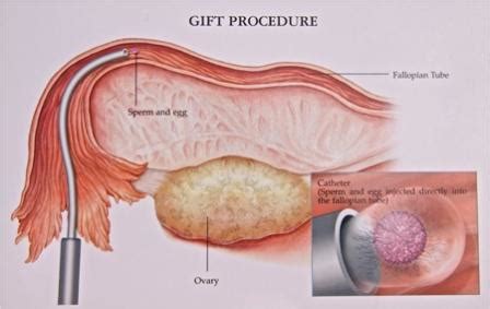 Infertility Treatment India : Gamete Intrafallopian Tube Transfer (GIFT) Treatment In India