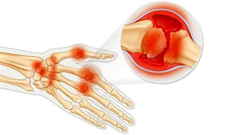 vitamin d for arthritis dosage – Jeff T Bowles