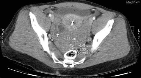 Ruptured Ovarian Cyst