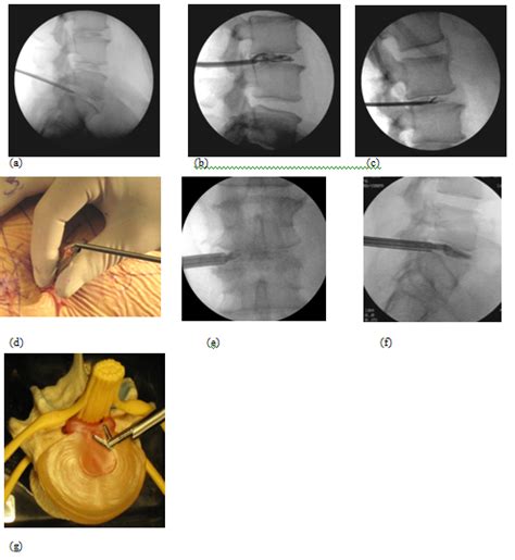 Minimally invasive endoscopic transforaminal lumbar discectomy, a ...