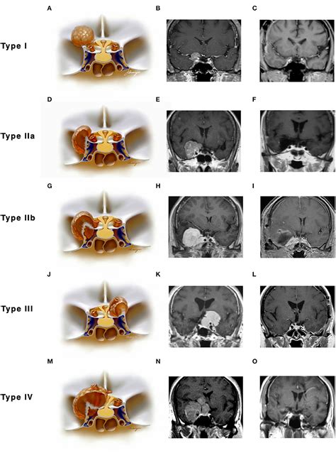 Frontiers | Anterior Clinoidal Meningiomas: Meningeal Anatomical Considerations and Surgical ...