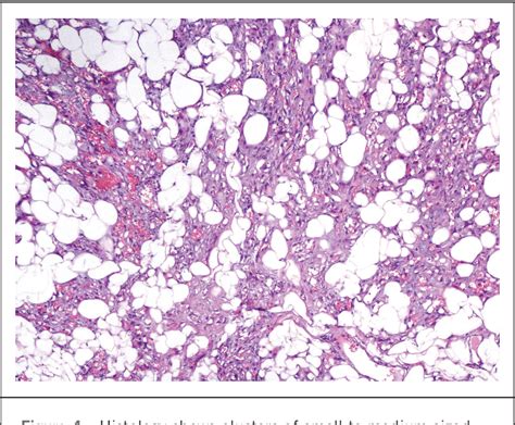 Figure 4 from Giant angiolipoma of the arm in an elderly patient ...