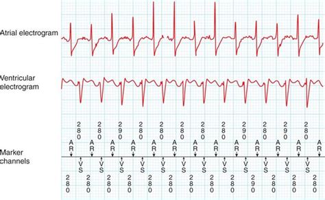 Ventricular Tachycardia Vs Svt | Hot Sex Picture