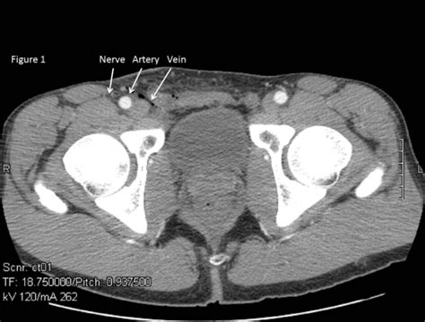 Anatomy Of The Femoral Nerve Artery And Vein Medical Illustration | The Best Porn Website