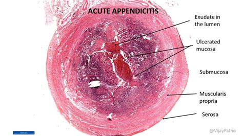 Acute Appendicitis Histology Diagram