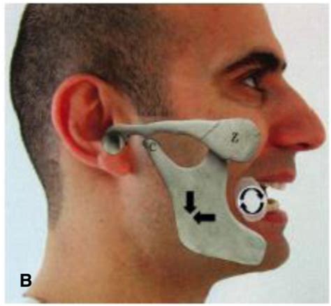 TMJ Dislocations: A Better Mousetrap? – Emergency Medicine Literature of Note