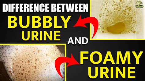 #shorts Difference Between Bubbly Urine and Foamy Urine | Kidney Treatment In Ayurveda - YouTube