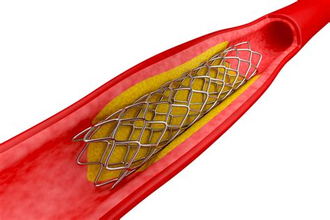 FDA Considers First-Ever Disappearing Heart Stent | Future of You ...