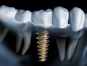 Osseointegration: The Science Behind Dental Implants