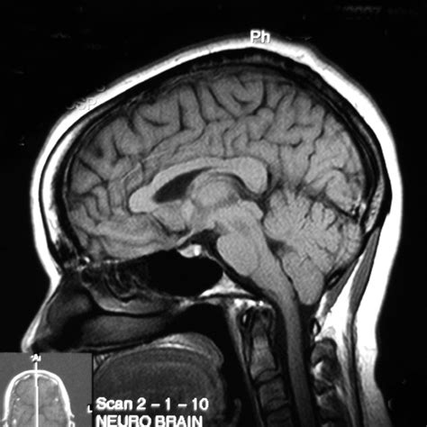 Chiari Medicine - Atlas