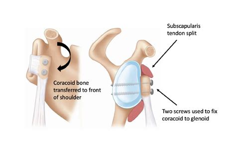 Latarjet Procedure | Shoulder Surgery | Sydney Shoulder Unit