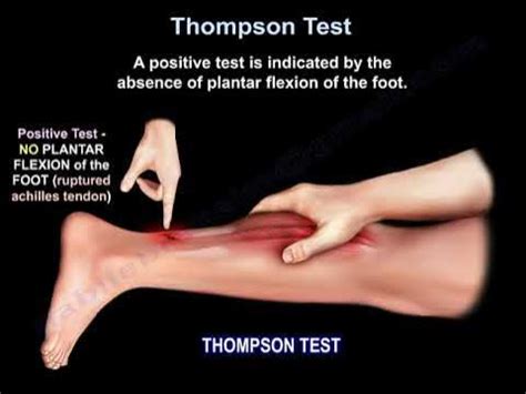 Thompson Test Achilles tendon tear - YouTube