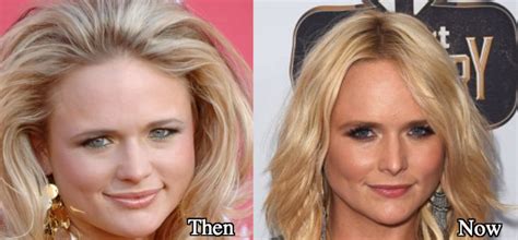 Miranda Lambert Plastic Surgery and Weight Loss Before and After Photos