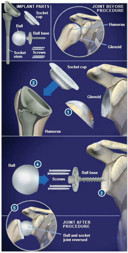 Reverse Total Shoulder Replacement | Central Coast Orthopedic Medical Group