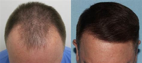 Top 170 + Forehead hair transplant before and after - polarrunningexpeditions