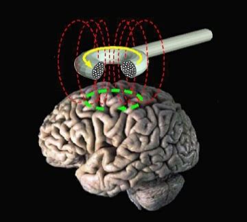 File:Transcranial magnetic stimulation.jpg - Wikipedia